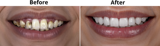 Before after